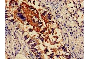 Immunohistochemistry of paraffin-embedded human lung tissue using ABIN7143831 at dilution of 1:100 (alpha Actinin 4 抗体  (AA 6-277))