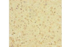 Immunohistochemistry of paraffin-embedded human glioma using ABIN7143220 at dilution of 1:100 (Diazepam Binding Inhibitor 抗体  (AA 2-105))