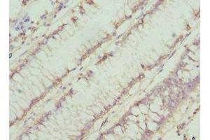 Immunohistochemistry of paraffin-embedded human colon cancer using ABIN7160753 at dilution of 1:100 (CHN1 抗体  (AA 1-200))
