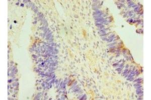Immunohistochemistry of paraffin-embedded human ovarian cancer using ABIN7150151 at dilution of 1:100 (APOBEC3C 抗体  (AA 1-190))