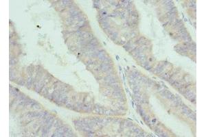 Immunohistochemistry of paraffin-embedded human endometrial cancer using ABIN7156846 at dilution of 1:100 (IL-2 抗体  (AA 25-176))