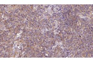 ABIN6273201 at 1/100 staining Human lymph cancer tissue by IHC-P.