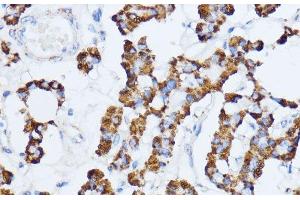 Immunohistochemistry of paraffin-embedded Human thyroid cancer using MAOA Polyclonal Antibody at dilution of 1:100 (40x lens). (Monoamine Oxidase A 抗体)