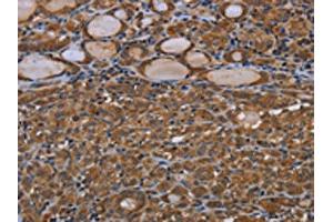 The image on the left is immunohistochemistry of paraffin-embedded Human thyroid cancer tissue using ABIN7190808(GJB4 Antibody) at dilution 1/40, on the right is treated with synthetic peptide.