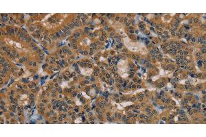 Immunohistochemistry of paraffin-embedded Human thyroid cancer using TAB3 Polyclonal Antibody at dilution of 1:35 (TAB3 抗体)