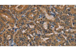 Immunohistochemistry of paraffin-embedded Human thyroid cancer using TAB3 Polyclonal Antibody at dilution of 1:35