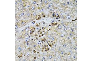 Immunohistochemistry of paraffin-embedded human liver injury using BEST1 antibody (ABIN6003520) at dilution of 1/100 (40x lens). (Bestrophin 1 抗体)