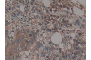 Detection of TEP1 in Human Breast cancer Tissue using Polyclonal Antibody to Telomerase protein component 1 (TEP1) (TEP1 抗体  (AA 2368-2627))