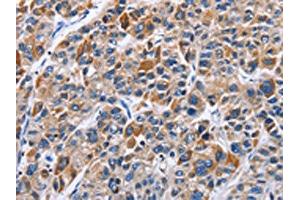 The image on the left is immunohistochemistry of paraffin-embedded Human liver cancer tissue using ABIN7129371(ENPP5 Antibody) at dilution 1/40, on the right is treated with fusion protein. (ENPP5 抗体)