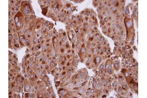 IHC-P Image Immunohistochemical analysis of paraffin-embedded human adrenal gland tumor, using SERTAD1, antibody at 1:100 dilution. (SERTAD1 抗体  (N-Term))