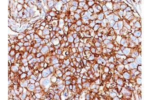 Formalin-fixed, paraffin-embedded human Breast Carcinoma stained with CD44 Mouse Monoclonal Antibody (HCAM/918). (CD44 抗体)
