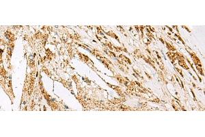 Immunohistochemistry of paraffin-embedded Human thyroid cancer tissue using DNPEP Polyclonal Antibody at dilution of 1:60(x200) (Aspartyl Aminopeptidase 抗体)
