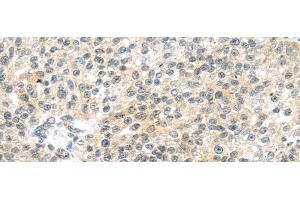 Immunohistochemistry of paraffin-embedded Human breast cancer tissue using TTBK2 Polyclonal Antibody at dilution 1:45 (TTBK2 抗体)