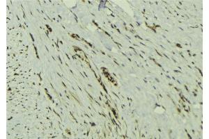 ABIN6273132 at 1/100 staining Human breast cancer tissue by IHC-P. (MAD2L2 抗体  (Internal Region))