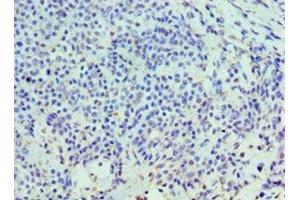 Immunohistochemistry of paraffin-embedded human breast cancer using ABIN7155973 at dilution of 1:100 (HYAL3 抗体  (AA 198-417))