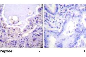 Immunohistochemical analysis of paraffin-embedded human lung carcinoma tissue using RAF1 polyclonal antibody . (RAF1 抗体)