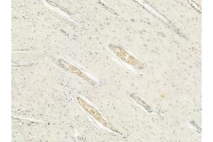 ABIN6260673 and ABIN6276631 at 1/100 staining human pancreatic carcinoma by IHC-P. (CDC20 抗体  (N-Term))