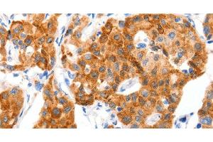 Immunohistochemistry of paraffin-embedded Human lung cancer tissue using GLUT-4 Polyclonal Antibody at dilution 1:70 (GLUT4 抗体)