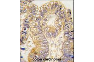 Formalin-fixed and paraffin-embedded human colon carcinoma tissue reacted with CLIC5 antibody , which was peroxidase-conjugated to the secondary antibody, followed by DAB staining. (CLIC5 抗体)