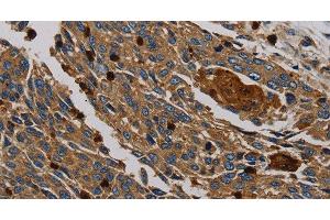 Immunohistochemistry of paraffin-embedded Human lung cancer tissue using PER2 Polyclonal Antibody at dilution 1:50 (PER2 抗体)