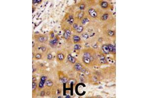 Formalin-fixed and paraffin-embedded human hepatocellular carcinoma tissue reacted with HNMT polyclonal antibody , which was peroxidase-conjugated to the secondary antibody, followed by DAB staining. (HNMT 抗体  (N-Term))