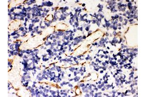Anti- Hsp47 Picoband antibody, IHC(P) IHC(P): Human Lung Cancer Tissue (SERPINH1 抗体  (AA 247-418))