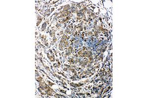 Anti-Bag3 antibody, IHC(P) IHC(P): Human Mammary Cancer Tissue (BAG3 抗体  (C-Term))