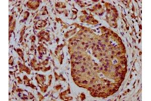IHC image of ABIN7166183 diluted at 1:400 and staining in paraffin-embedded human pancreatic cancer performed on a Leica BondTM system. (C1orf38 抗体  (AA 62-177))