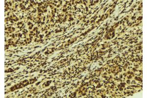 ABIN6274181 at 1/100 staining Human breast cancer tissue by IHC-P. (UBTF 抗体  (Internal Region))