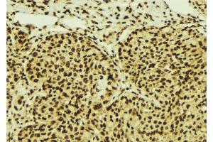 ABIN6274549 at 1/100 staining Human breast cancer tissue by IHC-P. (ZNF148 抗体  (N-Term))
