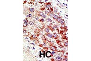 Formalin-fixed and paraffin-embedded human hepatocellular carcinoma tissue reacted with CBLC polyclonal antibody  , which was peroxidase-conjugated to the secondary antibody, followed by AEC staining. (CBLC 抗体  (N-Term))