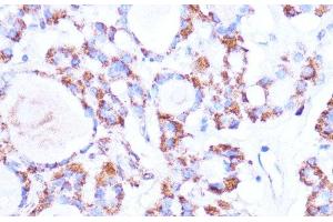 Immunohistochemistry of paraffin-embedded Human thyroid cancer using ISG15 Polyclonal Antibody at dilution of 1:100 (40x lens). (ISG15 抗体)
