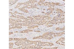 IHC analysis of Cytokeratin 19 using anti-Cytokeratin 19 antibody (ABIN3043288). (Cytokeratin 19 抗体  (C-Term))