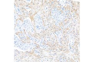 Immunohistochemistry (IHC) image for anti-Fibroblast Activation Protein, alpha (FAP) (AA 26-760) antibody (ABIN7453971) (Recombinant FAP 抗体  (AA 26-760))