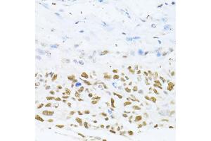 Immunohistochemistry of paraffin-embedded human lung cancer using DNMT1 antibody (ABIN5973205) at dilution of 1/100 (40x lens). (DNMT1 抗体)
