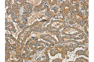 The image on the left is immunohistochemistry of paraffin-embedded Human thyroid cancer tissue using ABIN7190392(CWC27 Antibody) at dilution 1/40, on the right is treated with synthetic peptide. (Cwc27 抗体)