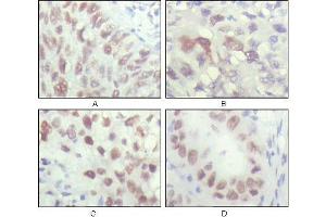 Immunohistochemical analysis of paraffin-embedded human lung carcinoma (A), liver carcinoma (B), breast carcinoma (C) and kiney carcinoma (D), showing nuclear localization with DAB staining using CHK2 mouse mAb. (CHEK2 抗体  (AA 481-531))