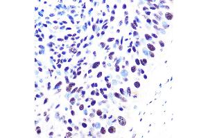 Immunohistochemistry of paraffin-embedded human esophageal cancer using 53BP1 Rabbit mAb (ABIN1679832, ABIN3018199, ABIN3018200 and ABIN7101582) at dilution of 1:100 (40x lens). (TP53BP1 抗体)