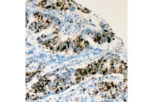 Immunohistochemical analysis of RRS1 staining in human colon cancer formalin fixed paraffin embedded tissue section. (RRS1 抗体)