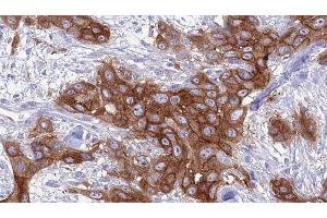 ABIN6277066 at 1/100 staining Human Head and neck cancer tissue by IHC-P. (GNA15 抗体  (C-Term))