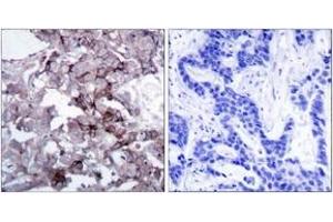 Immunohistochemistry analysis of paraffin-embedded human breast carcinoma tissue, using EGFR (Ab-1172) Antibody. (EGFR 抗体  (AA 1139-1188))