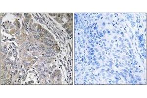 Immunohistochemistry analysis of paraffin-embedded human lung carcinoma, using SPINK6 Antibody. (SPINK6 抗体  (AA 13-62))