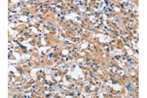 The image is immunohistochemistry of paraffin-embedded human thyroid cancer tissue using ABIN7129101(CUL7 Antibody) at dilution 1/35. (Cullin 7 抗体)