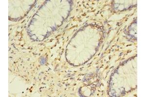 Immunohistochemistry of paraffin-embedded human colon cancer using ABIN7163017 at dilution of 1:100 (ETHE1 抗体  (AA 8-254))