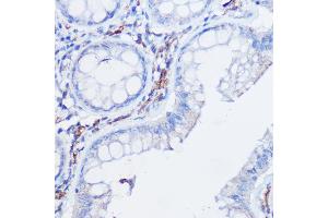 Immunohistochemistry of paraffin-embedded human colon carcinoma using CX3CR1 Rabbit pAb (ABIN3016929, ABIN3016930, ABIN1679440 and ABIN6219885) at dilution of 1:25 (40x lens). (CX3CR1 抗体)