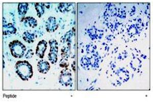 Immunohistochemical analysis of paraffin-embedded human breast carcinoma tissue, using Bsx polyclonal antibody . (BSX 抗体  (N-Term))