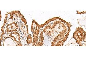 Immunohistochemistry of paraffin-embedded Human thyroid cancer tissue using GRASP Polyclonal Antibody at dilution of 1:150(x200) (Tamalin/GRASP 抗体)