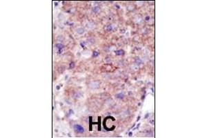 Formalin-fixed and paraffin-embedded human cancer tissue reacted with the primary antibody, which was peroxidase-conjugated to the secondary antibody, followed by DAB staining. (SMURF2 抗体  (C-Term))