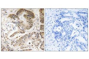 Immunohistochemistry analysis of paraffin-embedded human colon carcinoma tissue using PIK3R5 antibody. (PIK3R5 抗体  (C-Term))