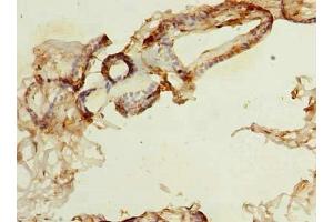 Immunohistochemistry of paraffin-embedded human breast cancer using ABIN7161118 at dilution of 1:100 (NDFIP1 抗体  (AA 2-116))